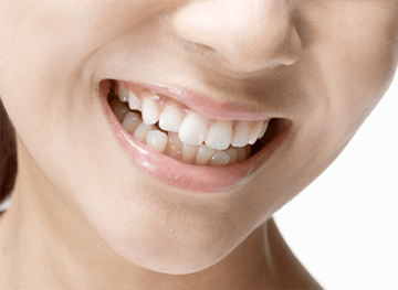 笑うと歯茎が出てしまう ガミースマイル治療について トクーナ
