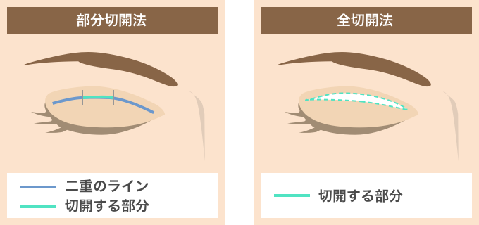 部分切開と全切開