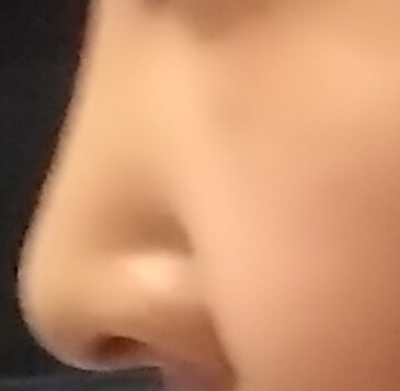 鼻の整形 (クレオパトラノーズ) 施術前