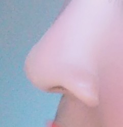 鼻の整形 (クレオパトラノーズ) 施術後