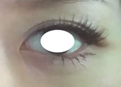 目元の整形、目のクマ治療 (目尻切開) 施術前