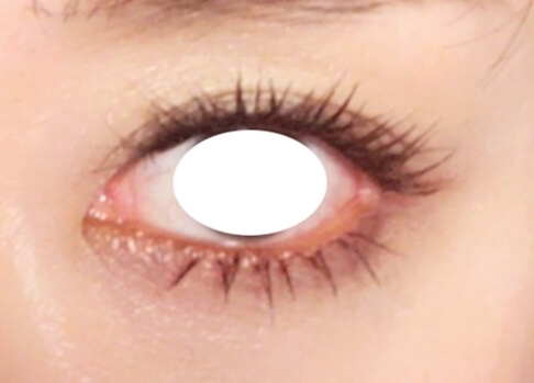 目元の整形、目のクマ治療 (目尻切開) 施術後