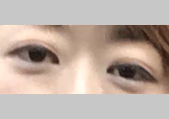 目・二重の整形 (眼瞼下垂 (挙筋短縮法)) 施術前