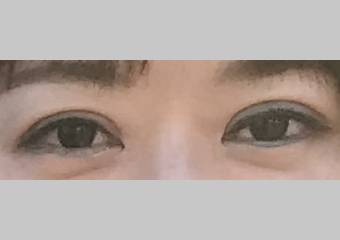 目・二重の整形 (眼瞼下垂 (挙筋短縮法)) 施術後
